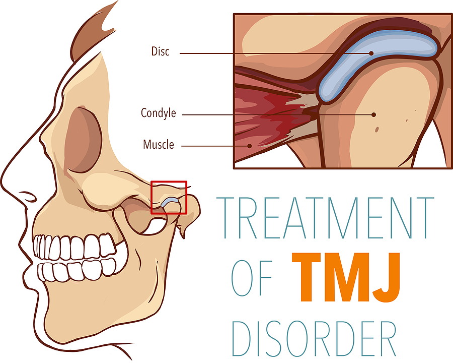 Comprehensive Care for TMJ in Palo Alto, CA